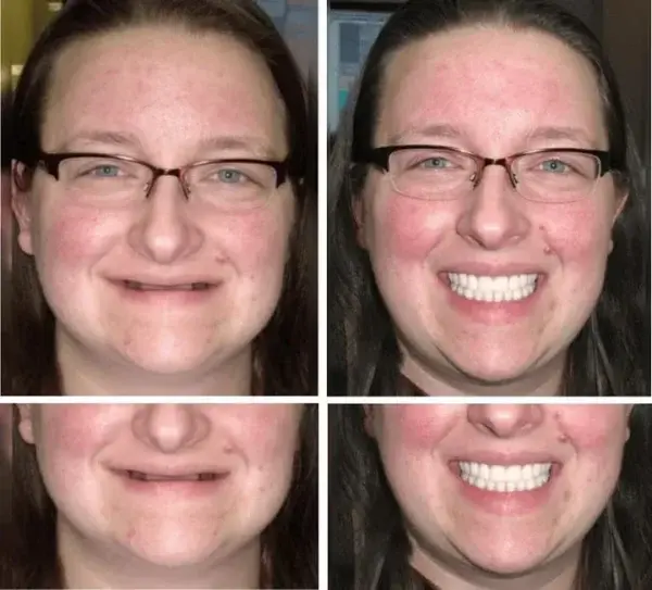 Custom-Fit Functional Denture - Image 9