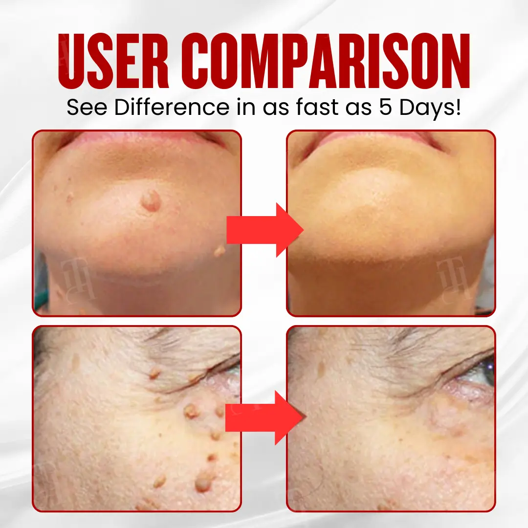 WartAway Pro Patches - Image 2