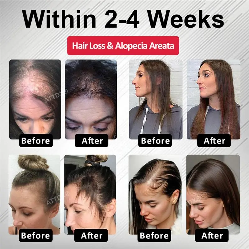 Hair Reawaken PP405 Roll-On Serum for Women - Image 2