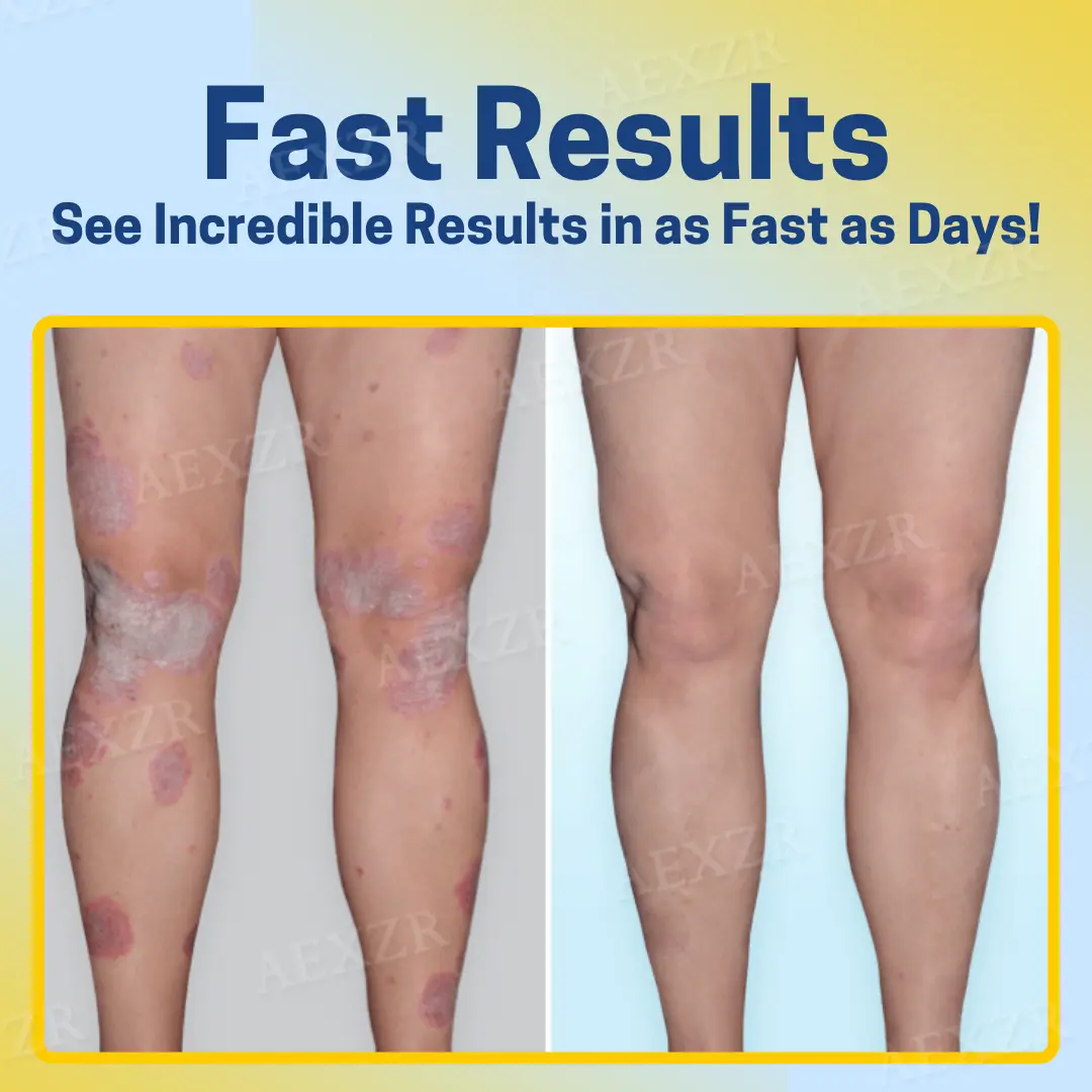 Bee Venom Psoriasis Treatment Spray - Image 6