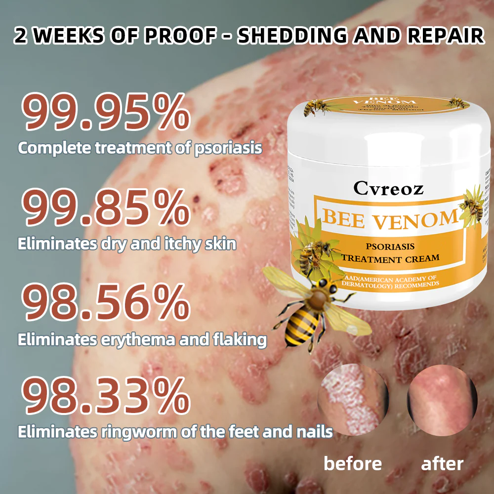 Cvreoz Bee Venom Psoriasis Treatment Cream - Image 2