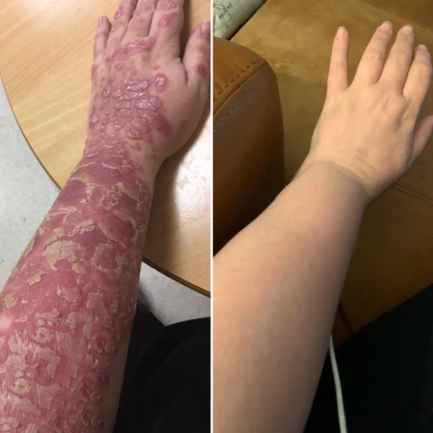 Cvreoz Bee Venom Psoriasis Treatment Cream - Image 4