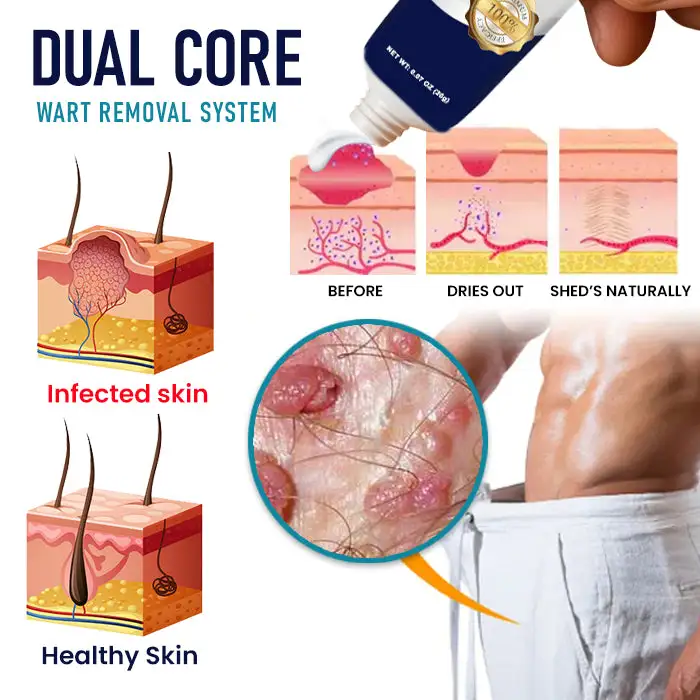 Genital Warts Remover Cream - Image 4