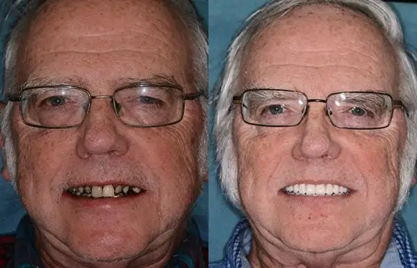 Advanced Customized Full Denture Set - Image 8