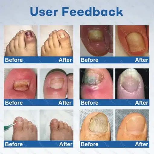 Nano Rapid Clear Nail Fungus Rapair Liquid Effective in Seven Days, Permanently Eliminates the Root - Image 4