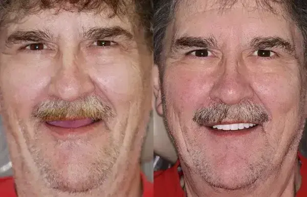 SmileFitPro Premium Denture - Image 10