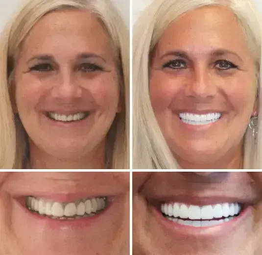 SmileFitPro Premium Denture - Image 5