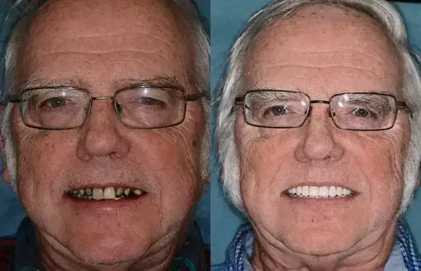 SmileFitPro Premium Denture - Image 8