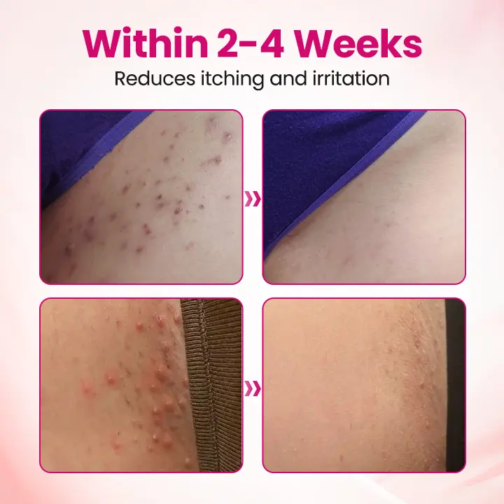 IntiDefend Anti-HPV Interferon Gel - Image 5