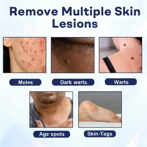 Mole and Wart Removal Cream - Image 3