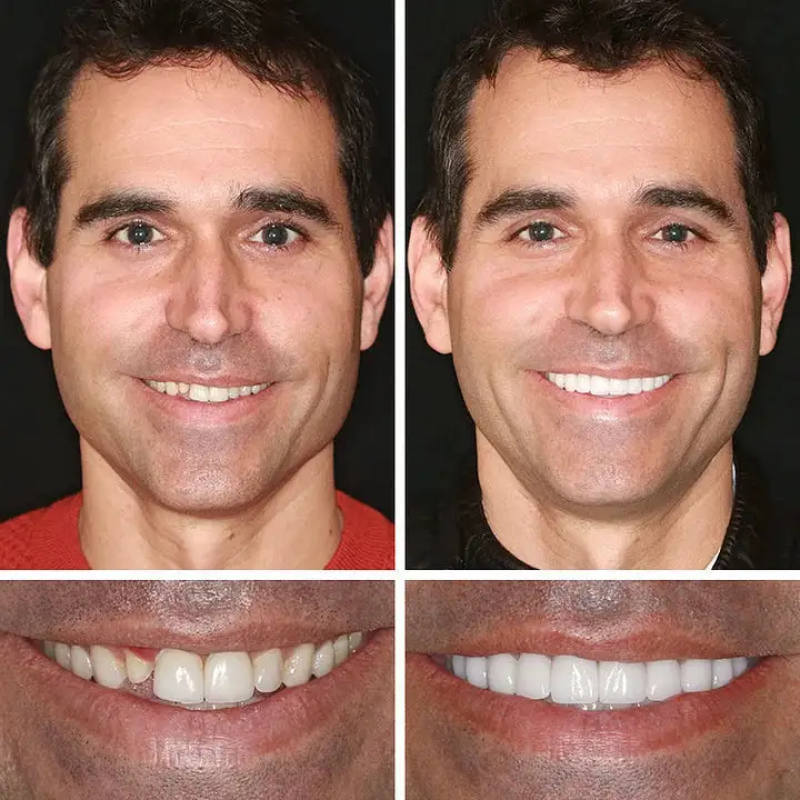 Medical Full Denture with Strong Suctiond - Image 9