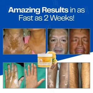 Alternative view of 14 PCS Left - VitiClear Bee Venom Cream | No More Hiding that Skin!💕