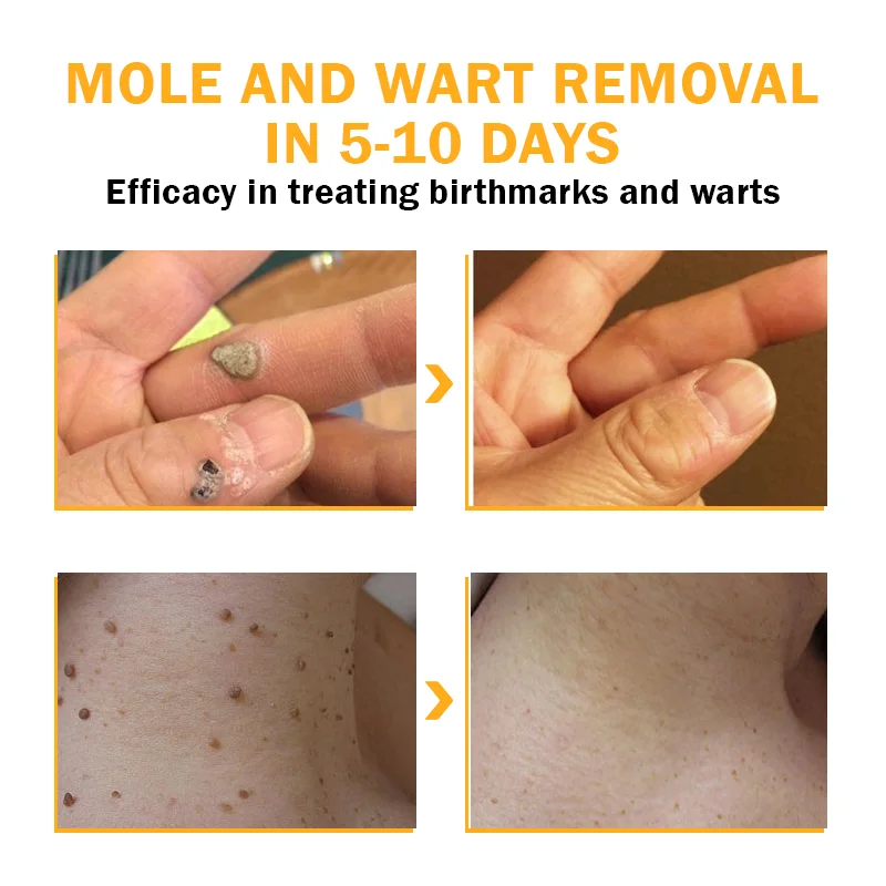 FlawlessFix Mole & Wart Removal Cream - Image 6