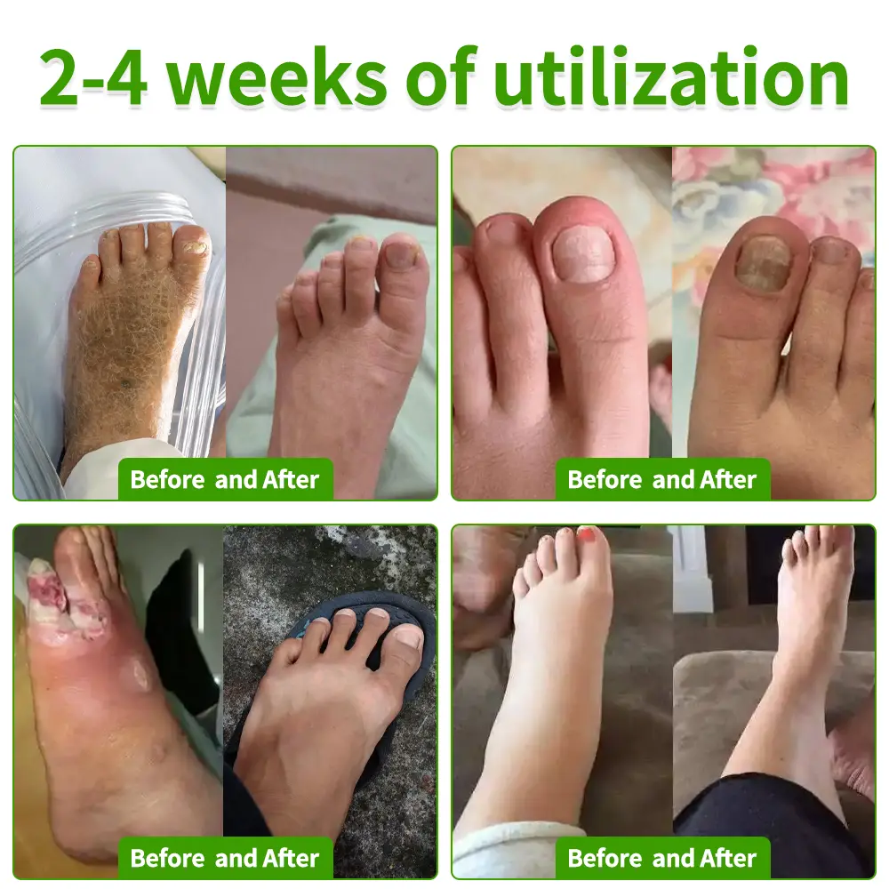 FungiVanish Foot Treatment Spray - Image 2