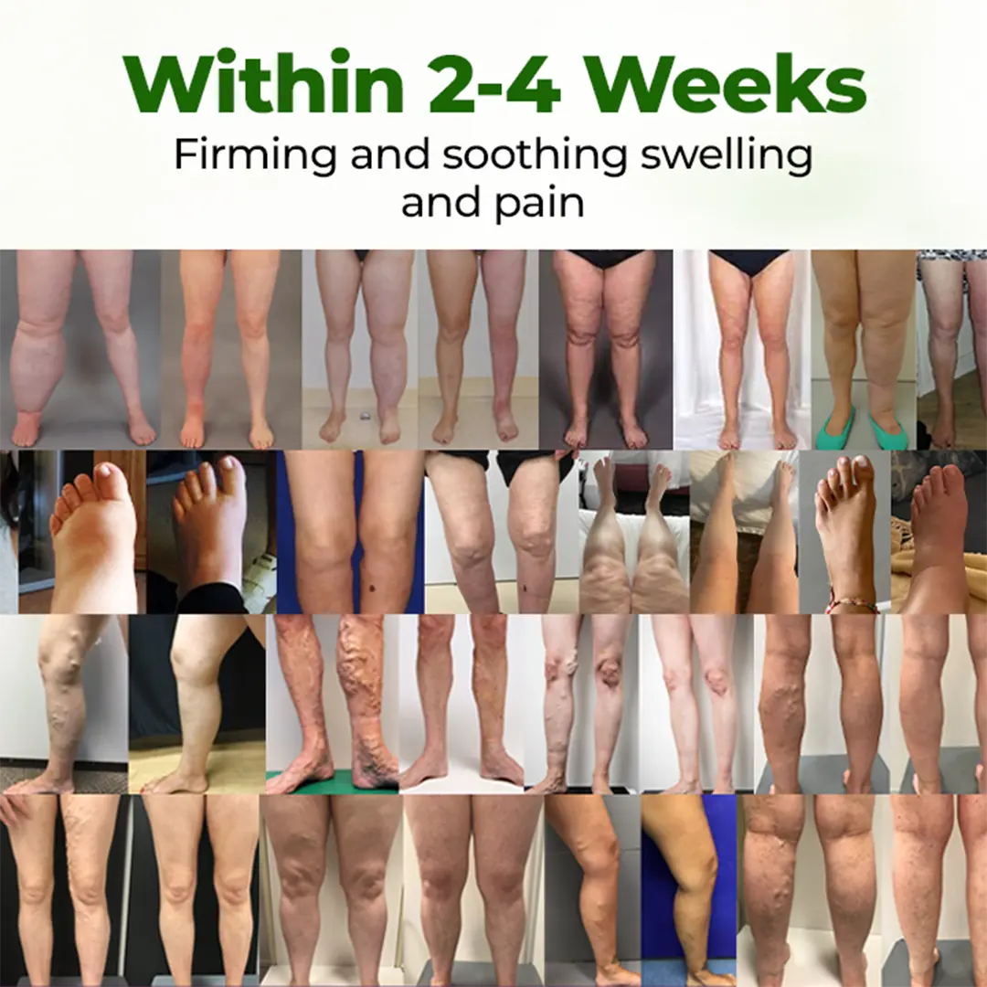 ๐ถ๐๐๐๐๐๐๐ ๐บ๐๐๐๐ Professional Leg Circulation Cream - Image 2