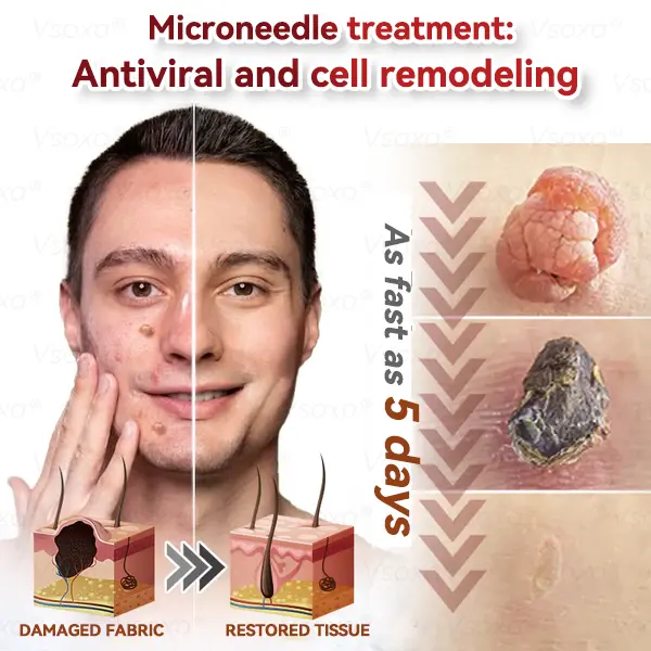 Microneedles Botanical Skin Tags Solution Patches - Image 12