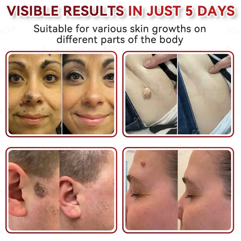 Microneedles Botanical Skin Tags Solution Patches - Image 4