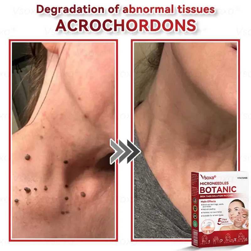 Microneedles Botanical Skin Tags Solution Patches - Image 5