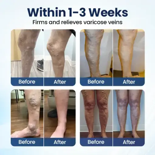 Deep Vein Repair Microneedle Patch - Image 2