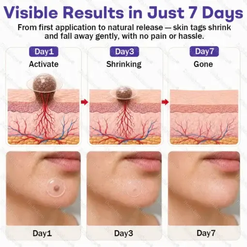 Wart and mole removal microneedle patch - Image 5