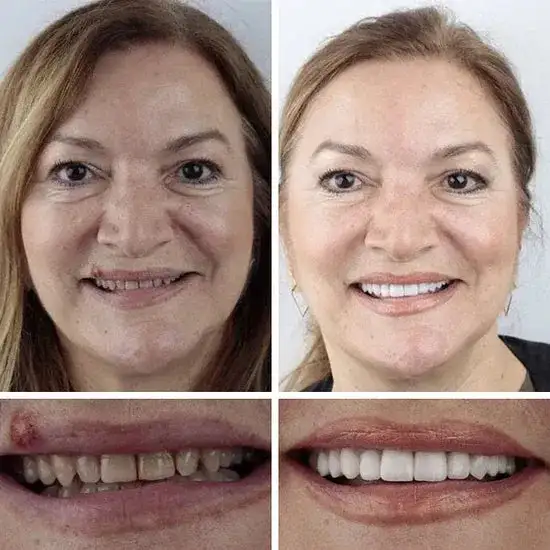 Custom-Fit Smile Support Kit - Image 22