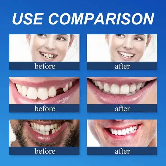 Custom-Fit Smile Support Kit - Image 8