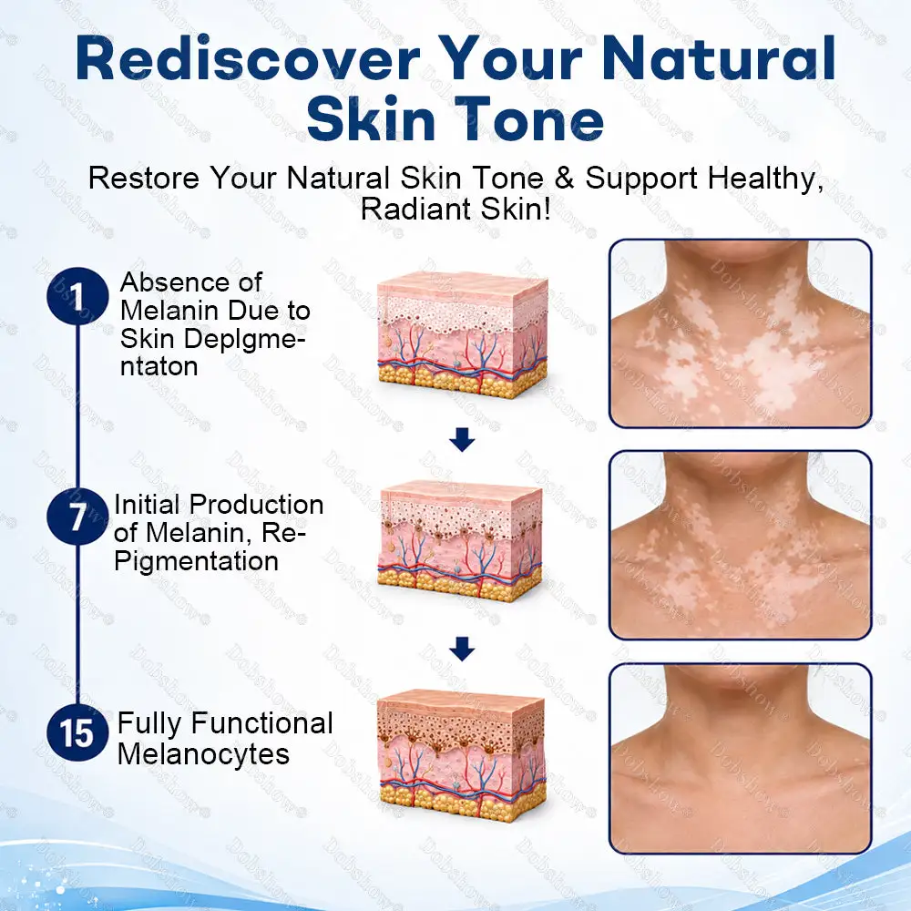 Advanced Piperine Vitiligo Repigmentation Spray - Image 2