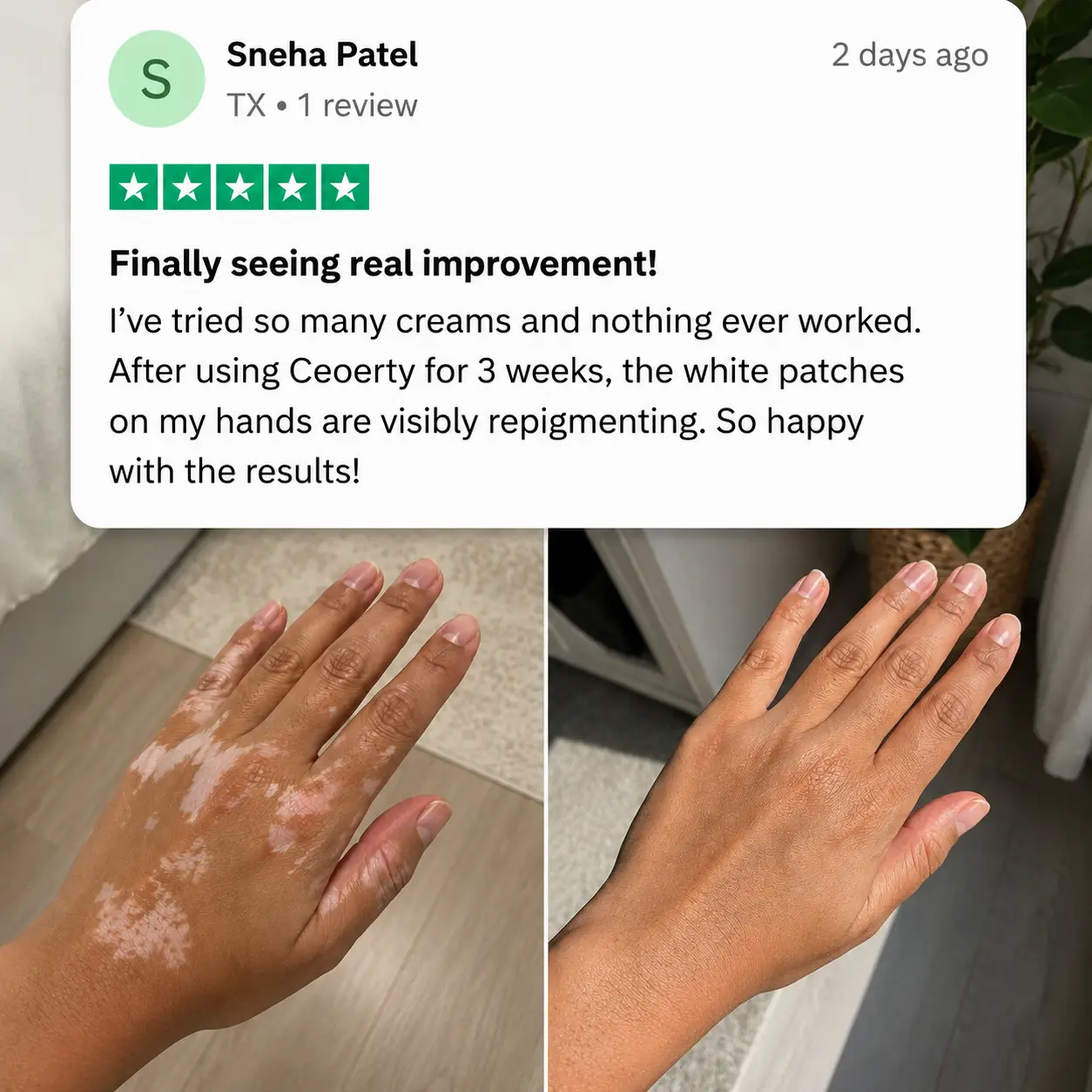 Herbal Vitiligo Cream - Image 3