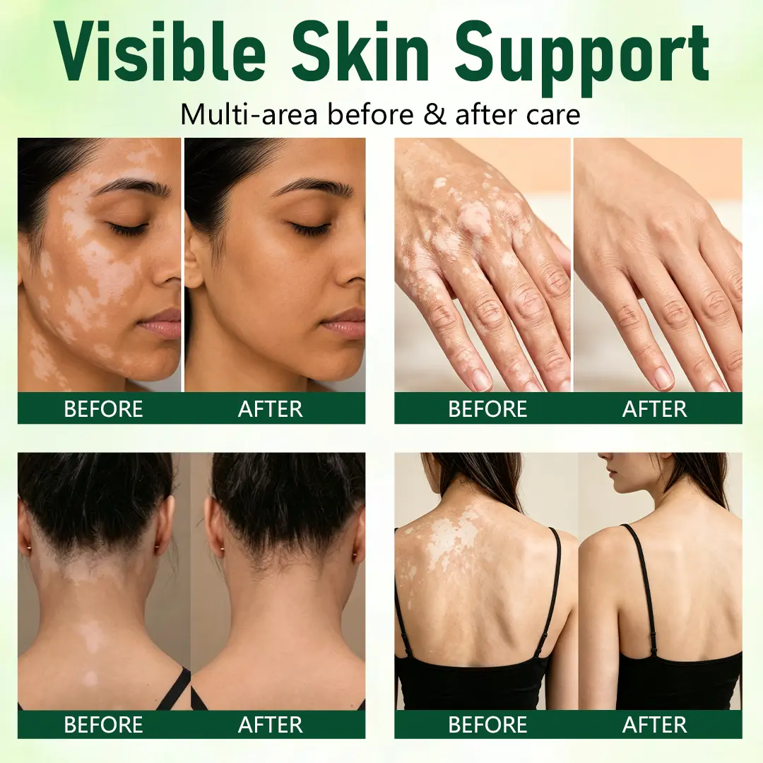 Herbal Vitiligo Cream - Image 4