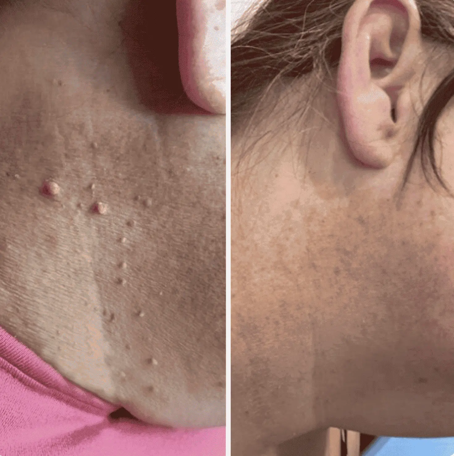 Painless Skin Tag Removal Kit - Image 5