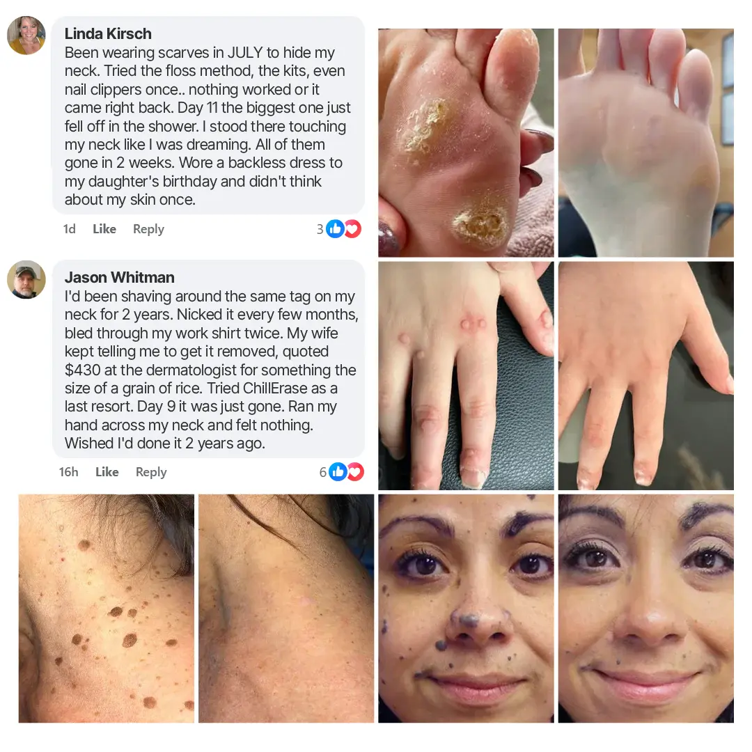 ChillErase Precision Skin Tag & Wart Removal Spray - Image 2