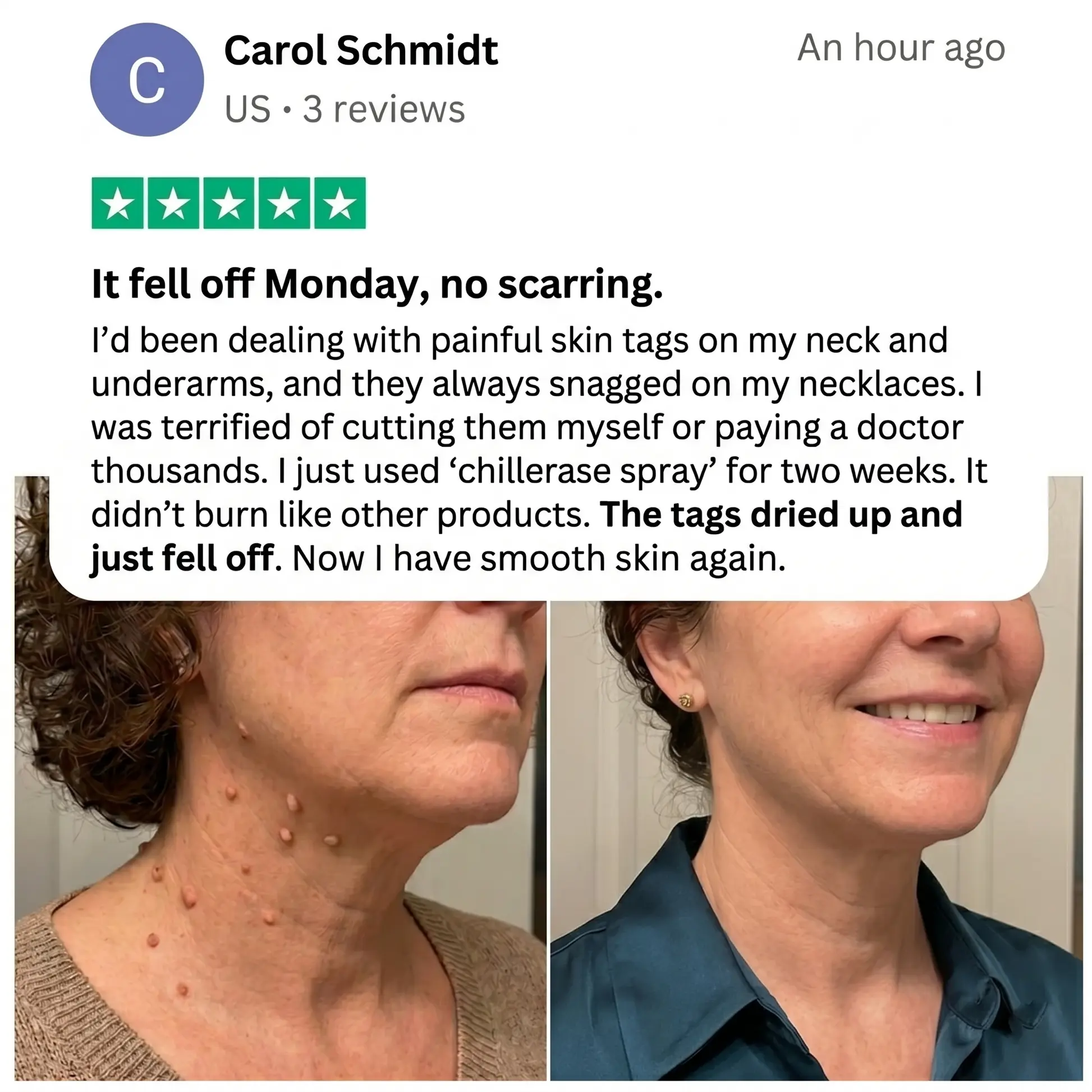 ChillErase Precision Skin Tag & Wart Removal Spray - Image 3