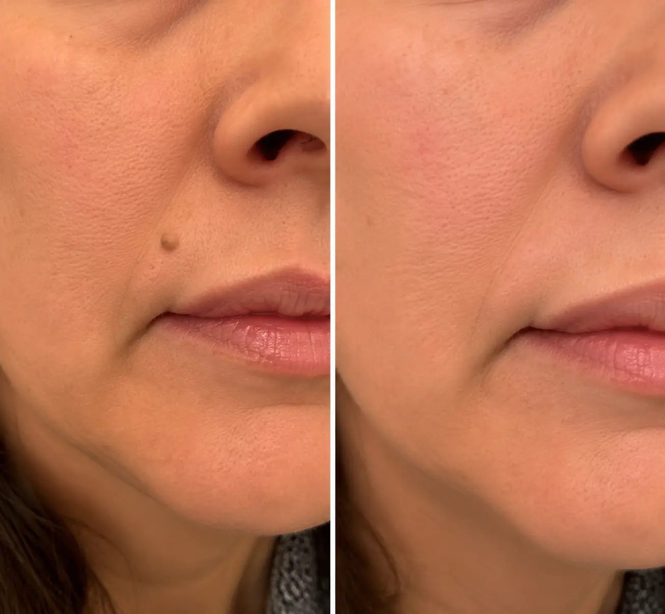 Parche 2 en 1 de Microneedles e Hidrocoloide - Image 7