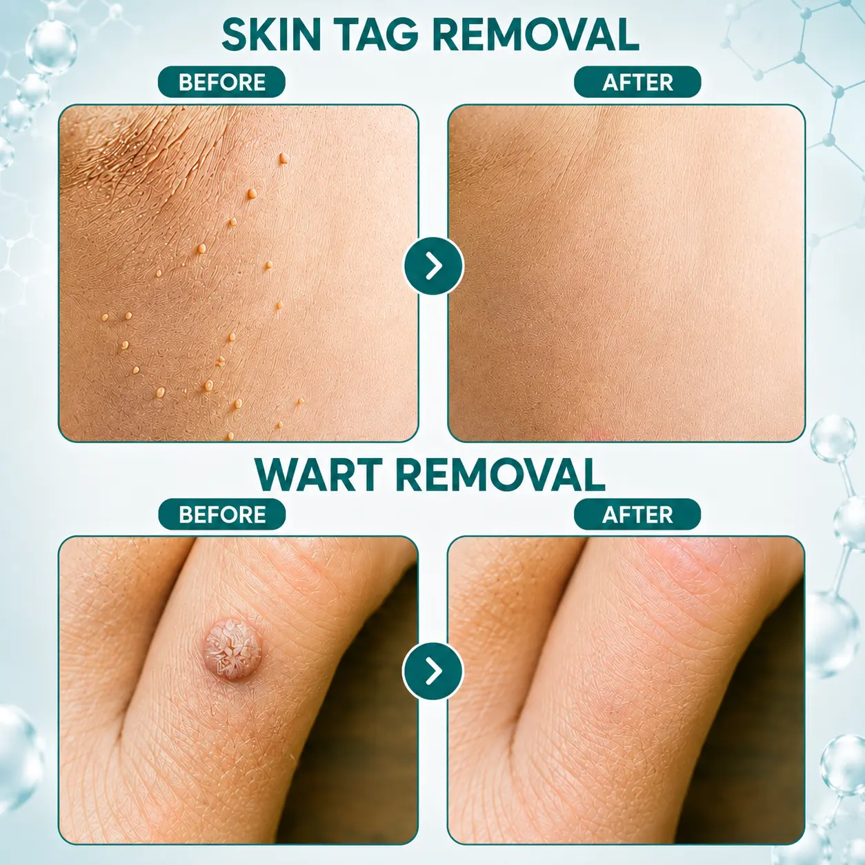 Blemish Clear Microneedle Patches - Image 3