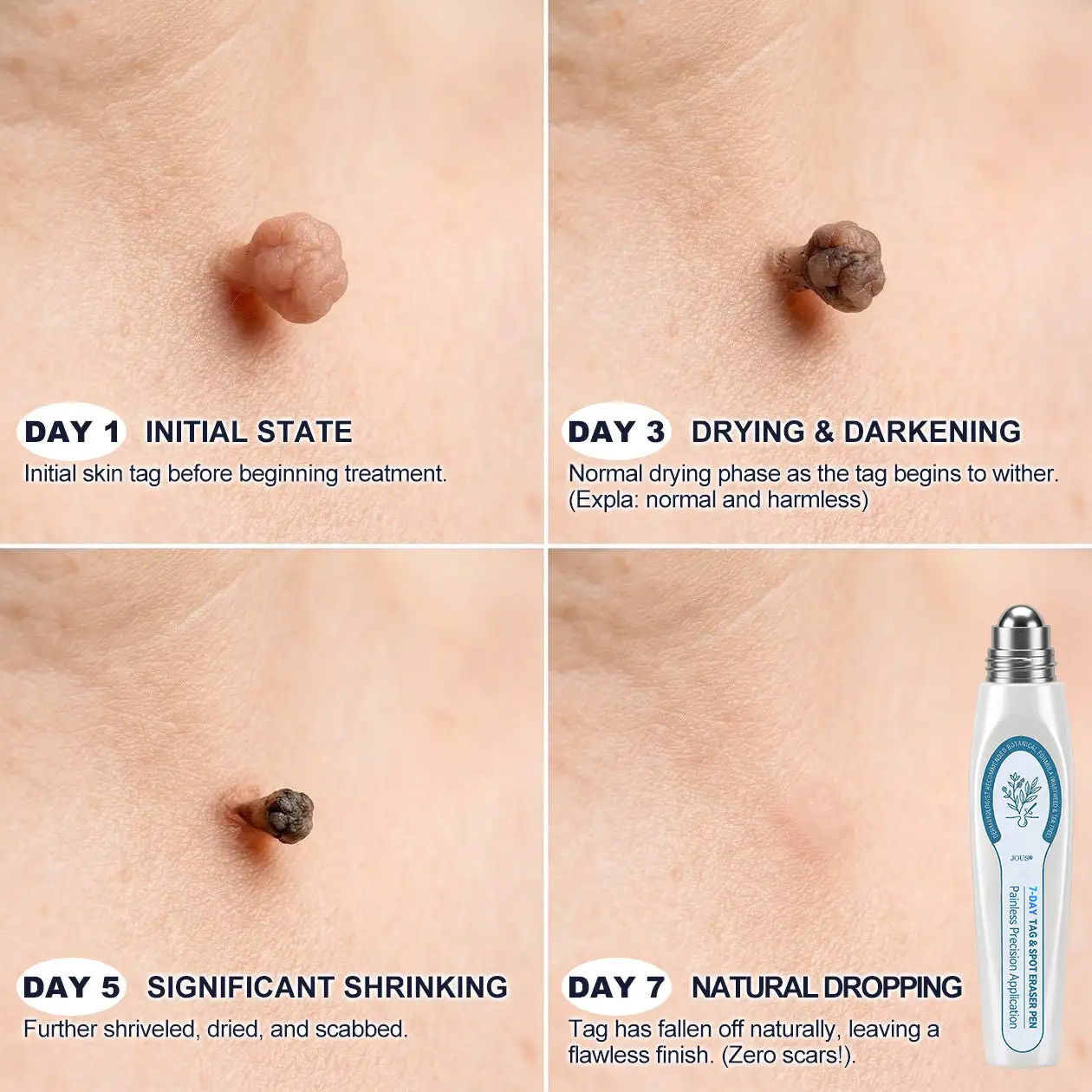 Advanced Wart Removal Gel · Fast-Drying Targeted Care for Common Warts - Image 4
