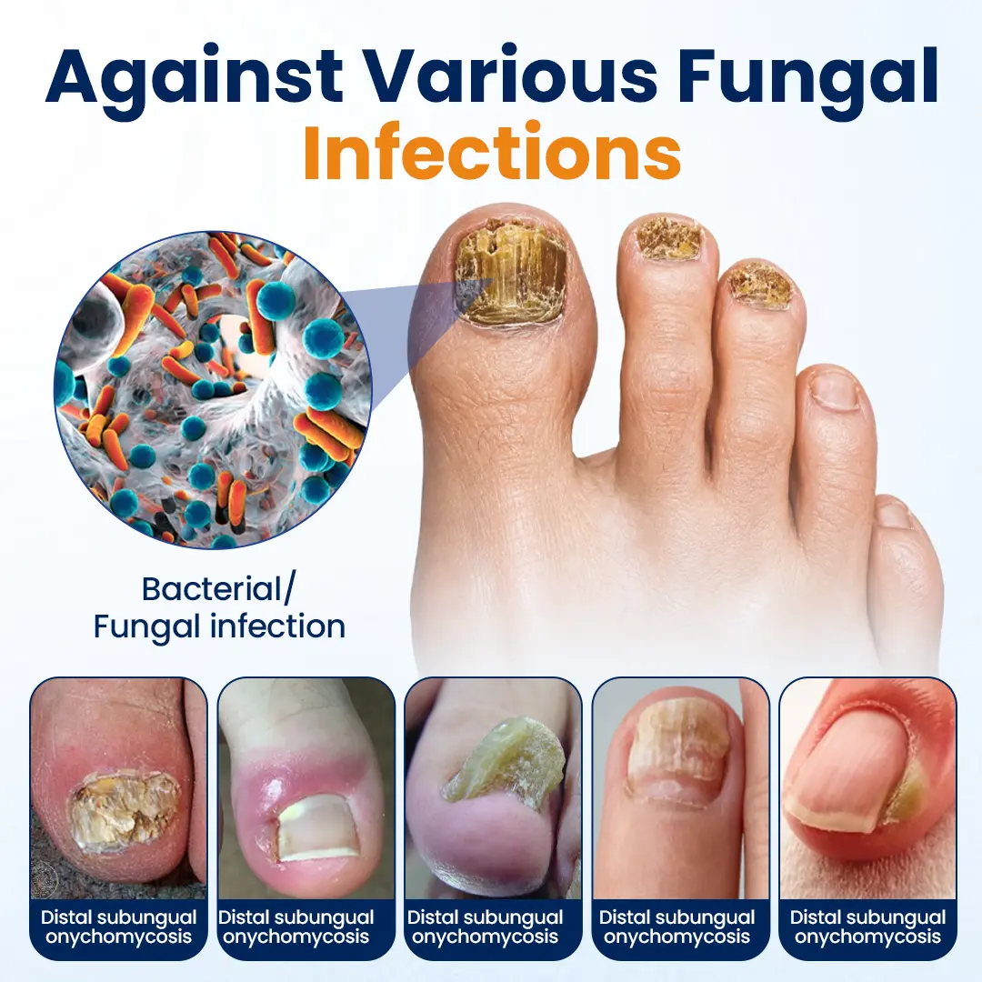 Nail fungus relief spray - Image 7