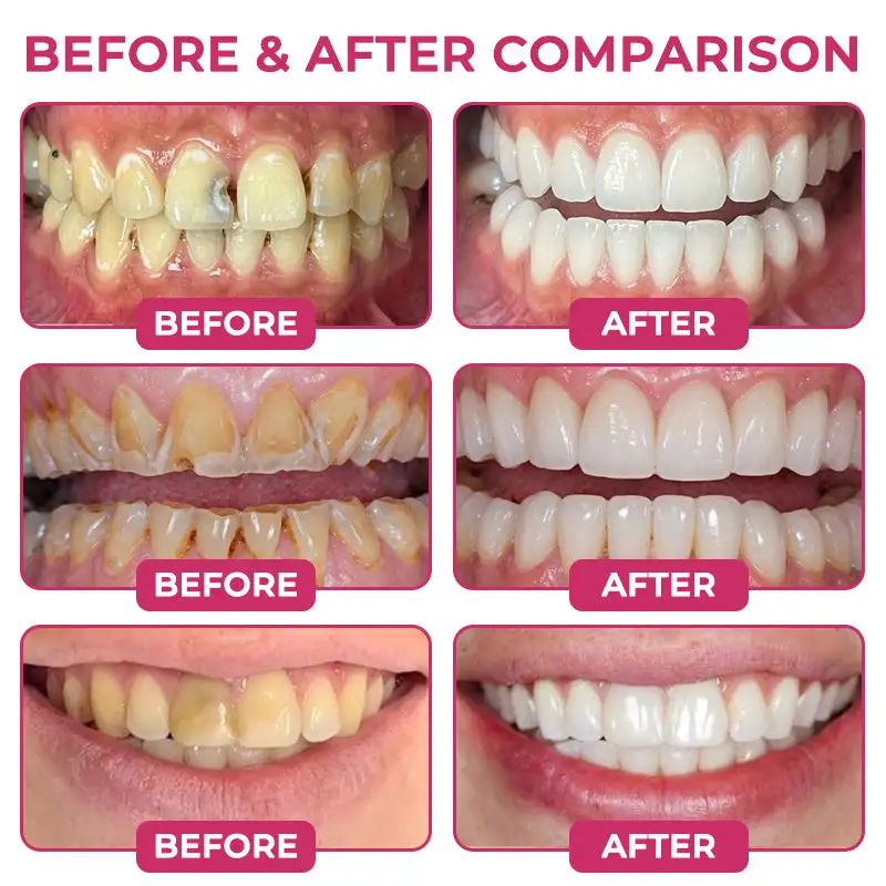 Cavity-Repair Natural Enamel Filling Gel - Image 3