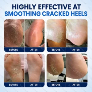 Alternative view of 2% Salicylic Acid Callus & Cracked Heel Spray