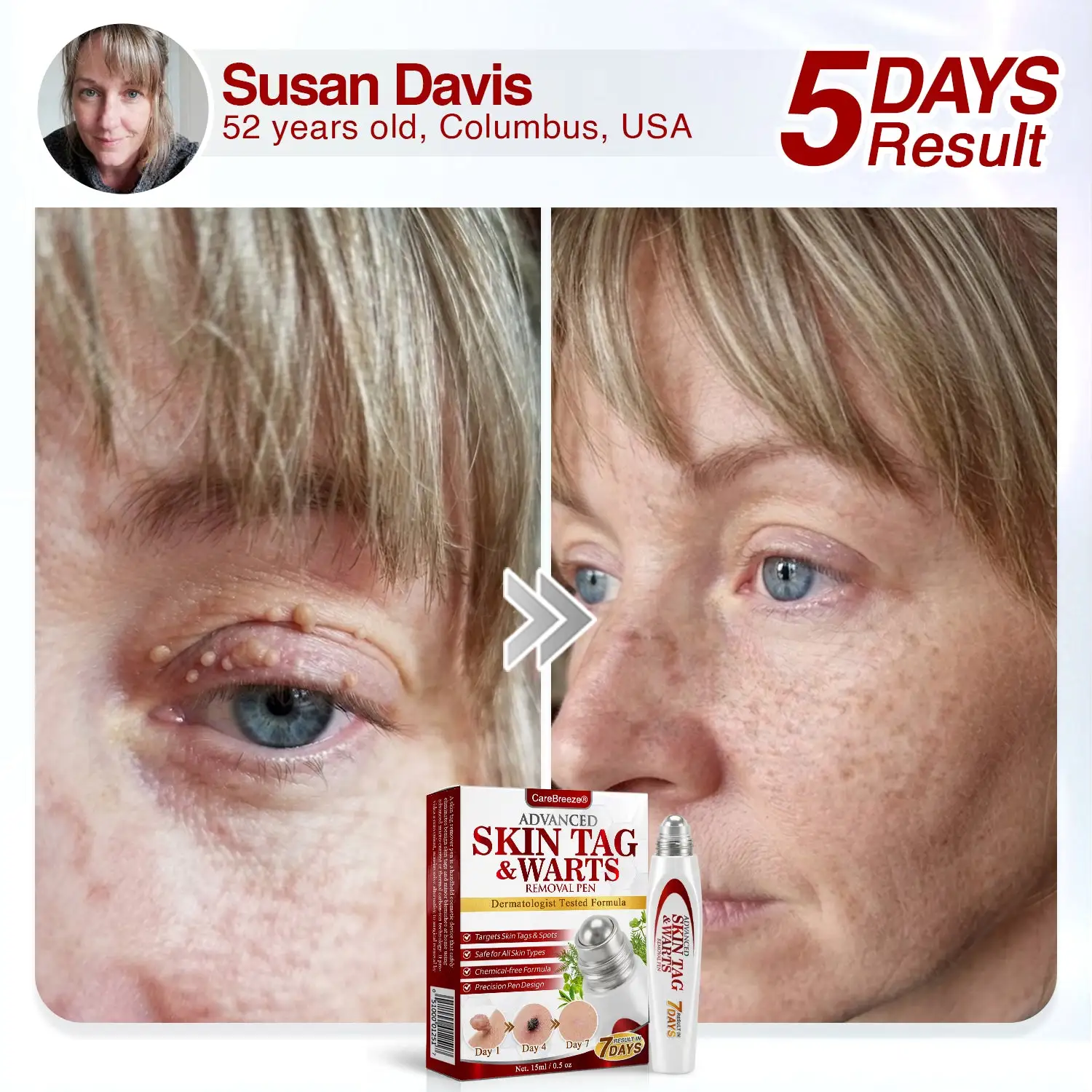 Herbal Skin Tag & Wart Removal Roller - Image 3