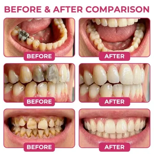 KLENIMORE DenPerm Cavity-Repair Natural Enamel Filling Gel - Image 2