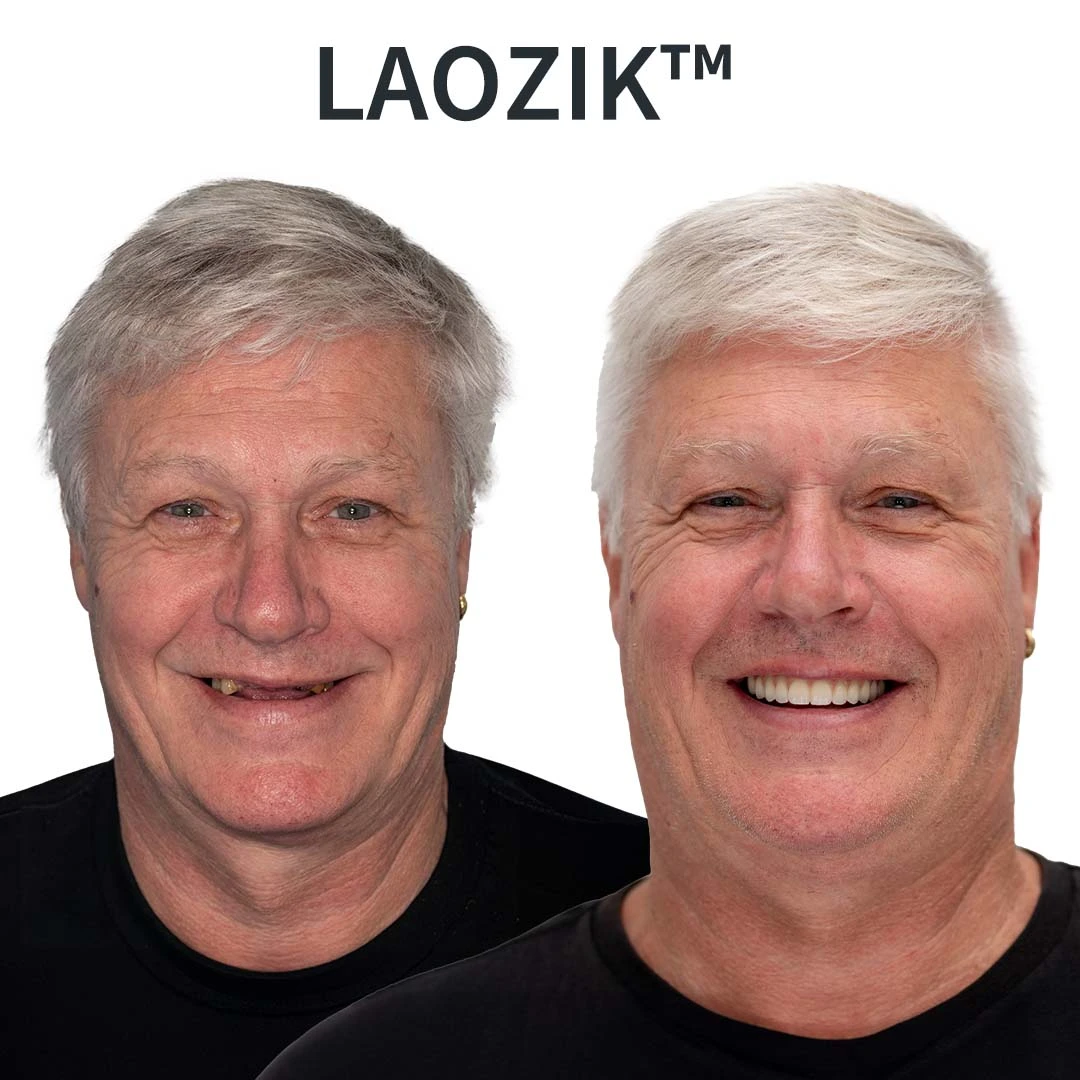 LAOZIKTM Custom-Fit Dentures - Image 15
