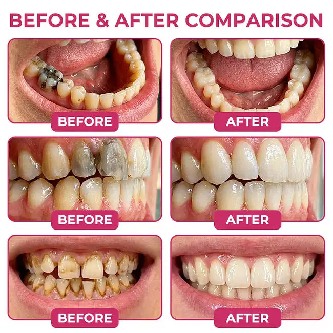 🦷 DenPerm Advanced Enamel Repair Biomimetic Protein Gel - Image 3