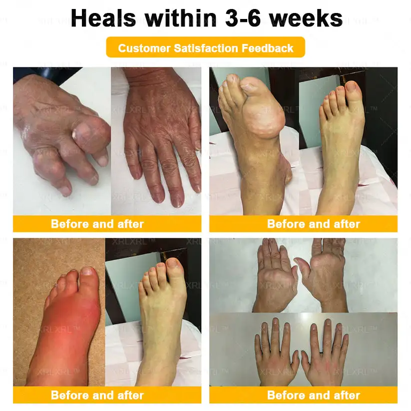 💞💞 Bee Venom Pain-Relief Bone Healing Cream - Image 4