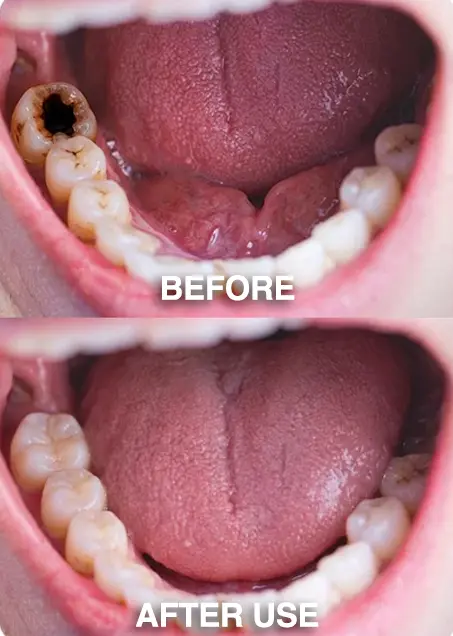 DenPerm – Natural Enamel Repair & Cavity Filling Gel - Image 11